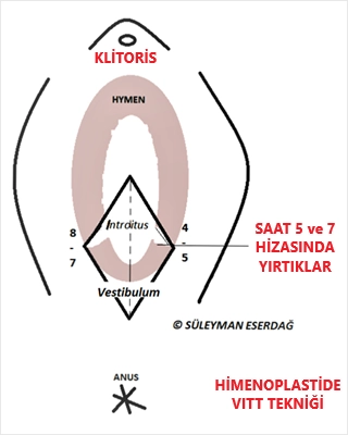 Kızlık Zarı Dikimi Nasıl Yapılır?